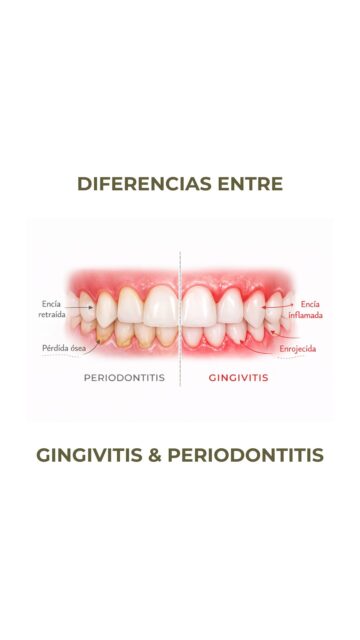 Gingivitis y periodontitis no son lo mismo.

La gingivitis es la fase inicial: encías inflamadas, enrojecidas y que pueden sangrar.

El hueso todavía no está afectado y es completamente reversible.

La periodontitis es una fase más avanzada.
La infección ya afecta al hueso que sostiene el diente y puede provocar retracción, movilidad e incluso pérdida dental.

La clave está en detectarlo a tiempo.
La gingivitis se revierte.
La periodontitis se controla, pero el hueso perdido no se recupera.

Si notas alguno de estos síntomas, pide valoración✨🦷

——
#estudiodentalintegral #laspalmas #odontologíaintegral #dentistalaspalmas #clínicadental
