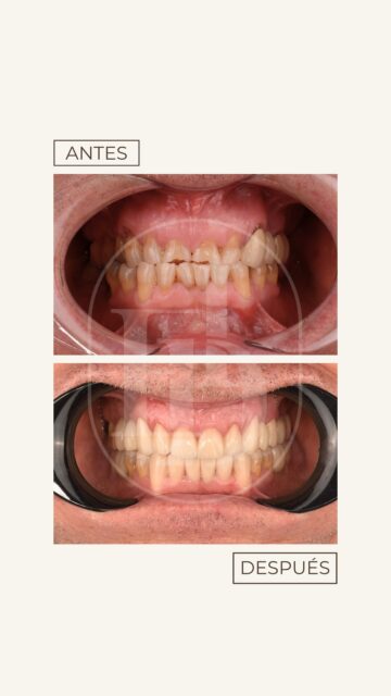 Con el paso del tiempo, el desgaste dental puede hacer que los dientes se acorten, afectando tanto la estética como la forma de masticar. 

Este paciente presentaba un importante desgaste dental que había provocado la pérdida de altura en su mordida, afectando tanto la función como la estética de su sonrisa.

Para devolverle una mordida equilibrada y una sonrisa natural, realizamos una rehabilitación oral completa con aumento de la dimensión vertical, mediante:
Coronas en los dientes anteriores superiores, carillas en los dientes anteriores inferiores, incrustaciones en los sectores posteriores e implantes y coronas en las zonas posteriores para recuperar las piezas ausentes.. Todas las restauraciones fueron realizadas en disilicato de litio, un material que combina gran resistencia y una estética excepcional.

El resultado que hemos conseguido ha sido una sonrisa más armónica y rejuvenecida, una mejor función masticatoria y una mayor comodidad en el día a día, siempre respetando la naturalidad, y por tanto, mejorando la calidad de vida del paciente.

#dentistalaspalmas #calidadevida #odontología #esteticadental #laspalmas