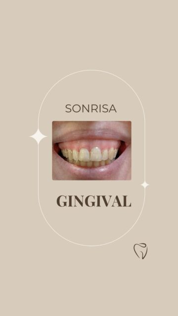 Hay sonrisas que no encajan en los cánones de belleza que nos ha impuesto la sociedad, y la sonrisa gingival es una de ellas. Pero eso no significa que sean menos bonitas ni que tengas que esconder la tuya.

Hoy te enseño los distintos tipos de sonrisa gingival que existen y, lo más importante, que todos tienen tratamiento.

Dar con un buen profesional es fundamental para encontrar la solución adecuada en cada caso. Si tu sonrisa te hace sentir incómodo o inseguro, te invito a venir a verme. Estaré encantada de ayudarte a conseguir una sonrisa con la que vuelvas a sentirte tú.

📍 Calle Benartemi 36

#SonrisaGingival #DentistaLasPalmas #EstéticaDental #SonríeSinMiedo #SaludBucodental