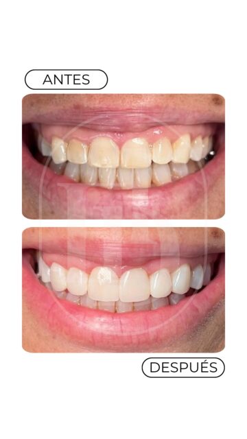 👏Les compartimos este precioso caso de carillas realizado por el doctor @drdiazdaniel 

Un diseño personalizado que devuelve la armonía, el brillo y la naturalidad. 

¿Y el resultado? Un paciente feliz y una sonrisa que habla por sí sola. 

🦷Si tú también quieres transformar tu sonrisa, agenda tu cita con nosotros📥

📍C/ Benartemi, 36. 

__

#dentistalaspalmas #odontologíaintegral #carillaslaspalmas #esteticadental